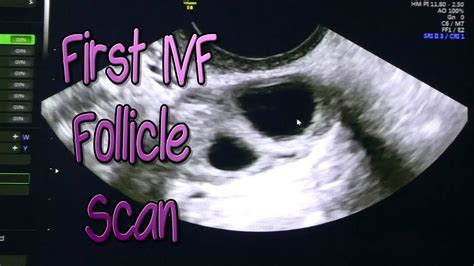 1st Ivf Follicle Scan How Many Are There Youtube