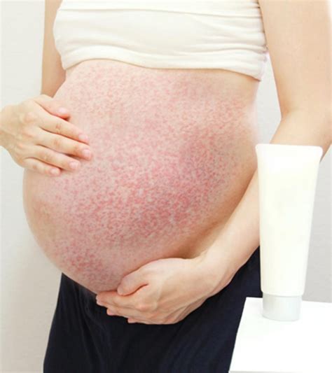 Puppp Rash In Pregnancy Prevention Treatment And Remedies