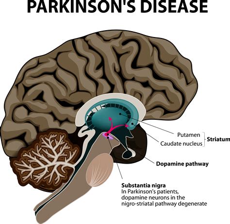 NUCCA and Parkinson's Disease: Important Facts and Help