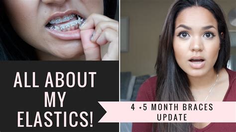 4 5 Month Adult Braces Update All About My Elastics Youtube