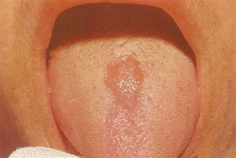 Glossitis Symptoms Causes Treatment Pictures