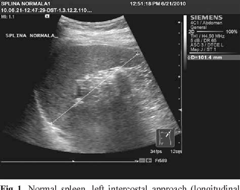 Figure 4 From The Ultrasound Examination Of The Spleen Semantic Scholar
