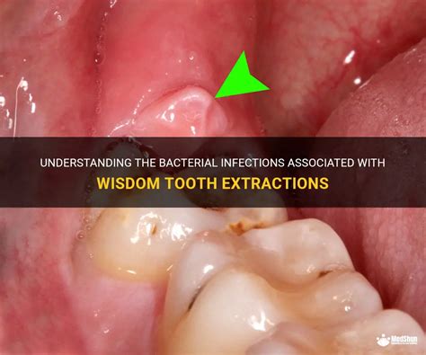 Understanding The Bacterial Infections Associated With Wisdom Tooth