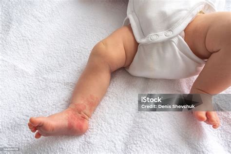 Hemangioma Red Birthmark On The Leg Of Newborn Baby Stock Photo