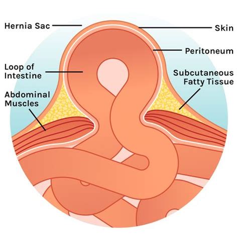 It causes a localized bulge in the abdomen or groin. What Is a Hernia? - How To Tell If You Have A Hernia