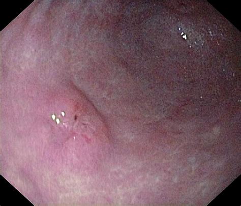 Early Gastric Cancer In The Stomach Photograph By Gastrolab Pixels