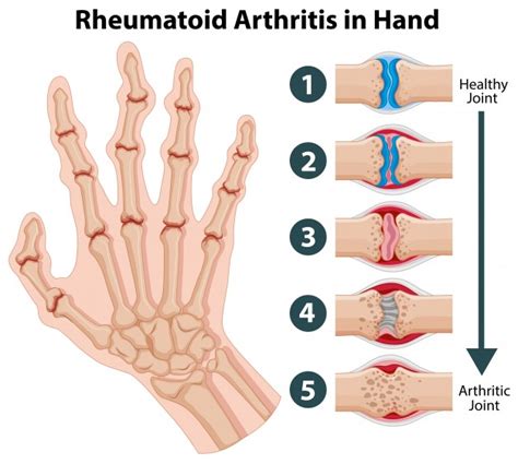 Fisioterapia Para Artritis Reumatoide L Ser Fisioterapia