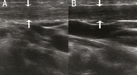A Vertical Section Of The Sternocleidomastoid Muscle Scm In A