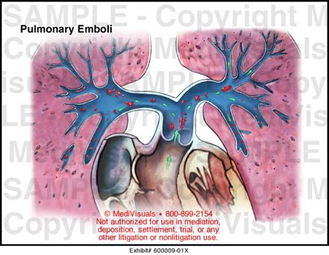 Medivisuals Pulmonary Emboli Medical Illustration