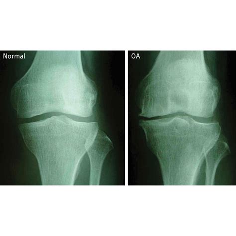 Osteoarthritis Pain Treatment Options Singapore Sports And Orthopaedics