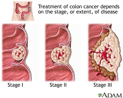 Colon Cancer Multimedia Encyclopedia Health Information St Luke