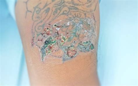 5 Causes Of A Tattoo Rash And How To Treat It 2022