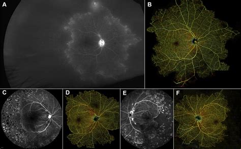 Widefield Oct Angiography Of Idiopathic Retinal Vasculitis Aneurysms