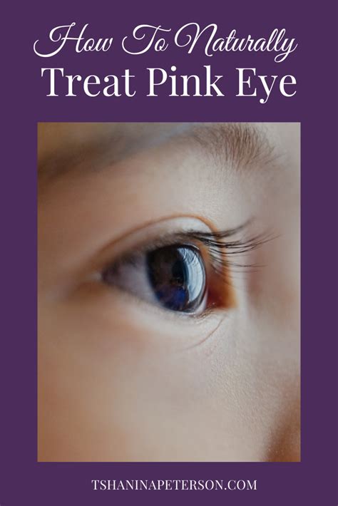 How To Naturally Treat Pink Eye Tshanina Peterson