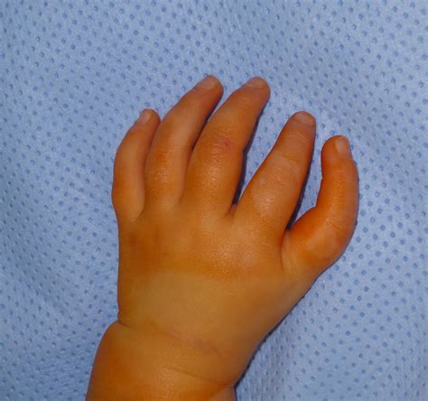 The 5 Finger Hand Congenital Hand And Arm Differences Washington