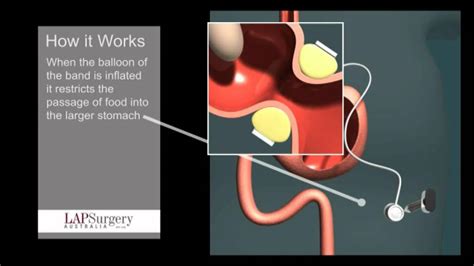 Lap Surgery Stomach Animation Youtube