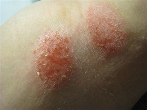 What Are The Causes Of Extremely Dry Patches Of Skin