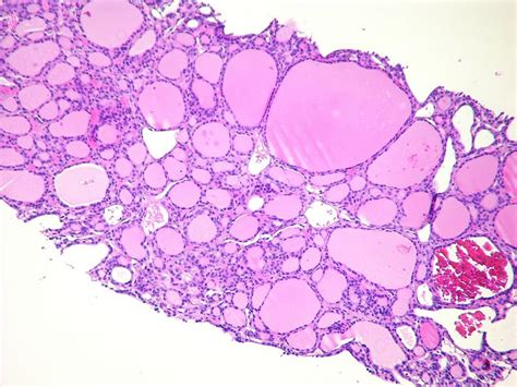 Follicular Thyroid Cancer Pathophysiology Wikidoc