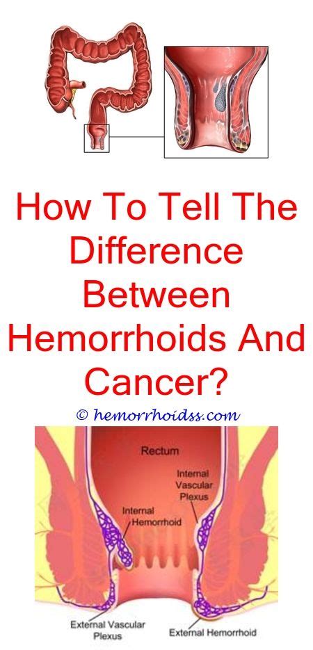 What Are Hemorrhoids Types Causes And Symptoms Otosection