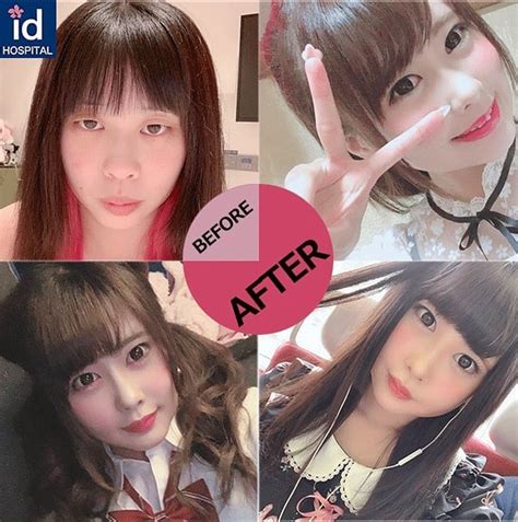 Japanese Plastic Surgery Before After