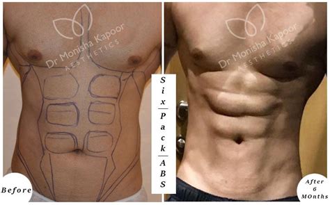 Six Pack Surgery For Men Abdominal Liposuction Men Liposuction