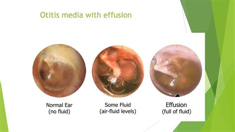 Image Result For Otitis Media With Effusion Otitis Media Otitis Media