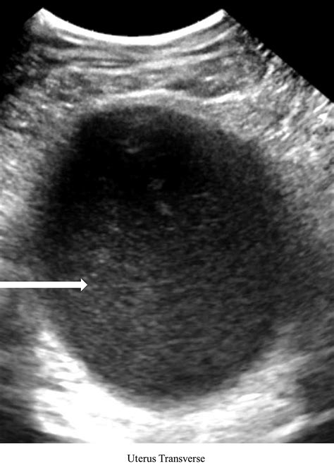 Cureus Imperforate Hymen And Hematometrocolpos In A Female With Back