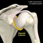 In such cases ct scan may be helpful. Labrum Tear of The Shoulder
