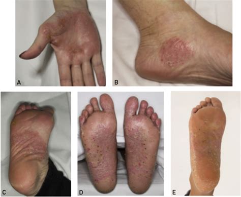Clinical Features Etiologic Factors Associated Disorders And Treatment Of Palmoplantar
