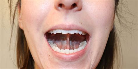 Can Adults Get Tongue Tie Treatment Royal Dental Clinics Blog