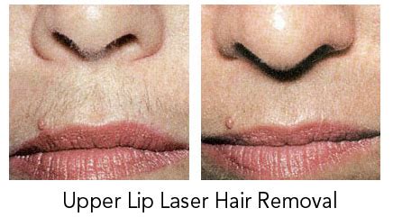 Upper Lip Laser Hair Removal Winnipeg Minuk Laser Centre Winnipeg Manitoba Canada