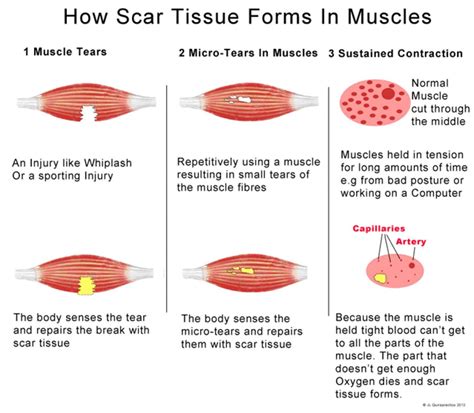 How Scar Tissue Forms In Muscles Visually Massage Therapy Scar