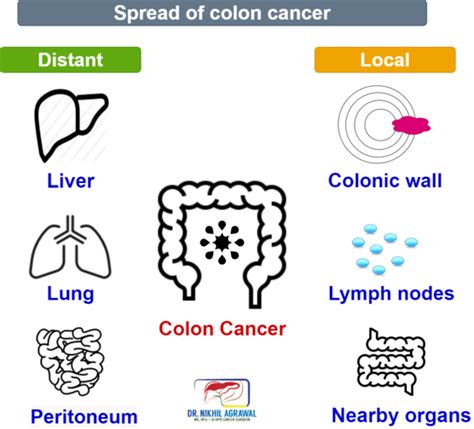 Colon Cancer Symptoms Causes And Treatment Dr Nikhil Agrawal