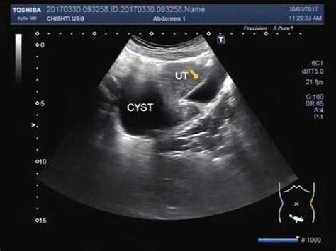 Ovarian Cyst On Ultrasound Image