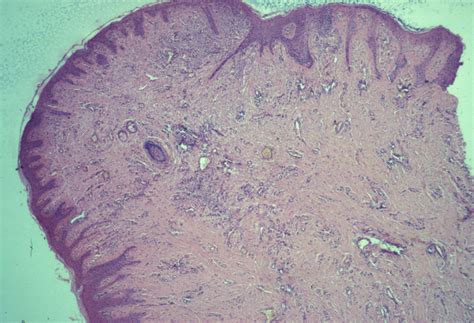 Acanthoma Granuloma Fissuratum Mucosae Oral Mucosa Acanthoma