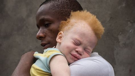 Democratic Republic Of Congo DRC Kinshasa Black Father Holding His Albino Babe