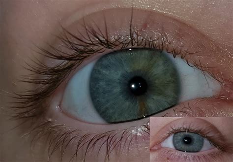 Do I Have Sectoral Heterochromia My Eyes Are Light Gray But One Of Them Has Weird Colored Spots