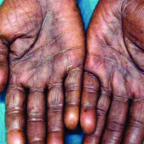 Hyperpigmentation On Dorsum Of Hands Download Scientific Diagram