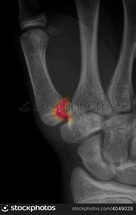 X Ray Showing Metacarpal Fracture At Base Of Thumb —
