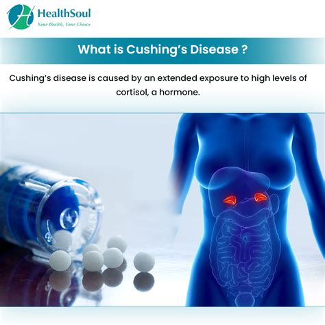 Cushings Disease Symptoms Diagnosis And Treatment Healthsoul