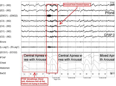Central sleep apnea and afib, obstructive sleep apnea risk 