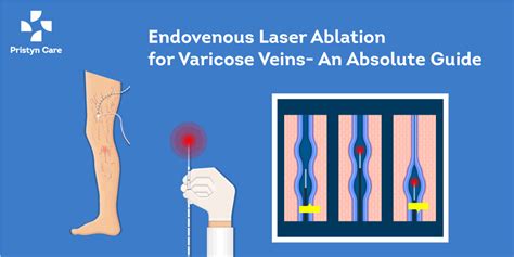 Endovenous Laser Ablation Of Varicose Veins An Absolute Guide