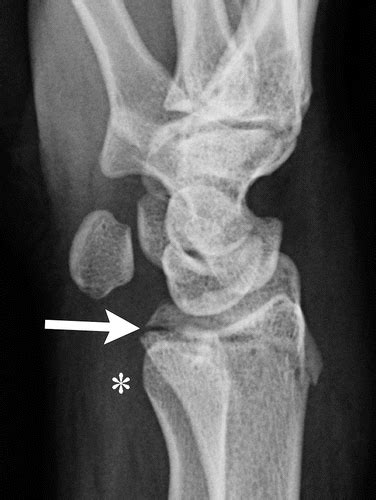 Pediatric Distal Forearm And Wrist Injury An Imaging Review