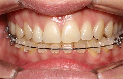 Lingual Orthodontics By Dr Issembert Orthodontist