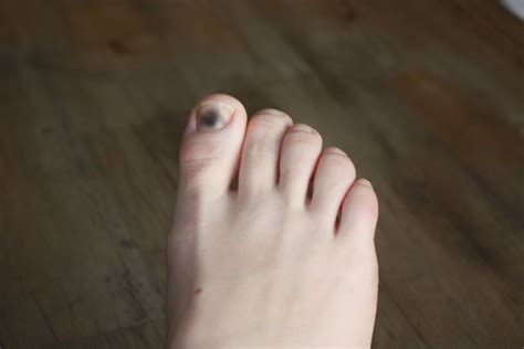 Hi there, i have a brown spot on my toenail for over a year now.it's been hidden under my nail polish for months and i just removed the nail thanks, i've uploaded a picture of both my toes, as it seems the brown patch is starting to appear on the left toe as well (but not as dark as the right toe). How to Clear Up Dark Toenails (with Pictures) | eHow
