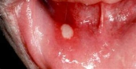 White Sore In The Mouth How To Treat The Disease