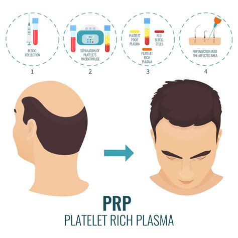 Prp For Hair Loss Dtap Clinic