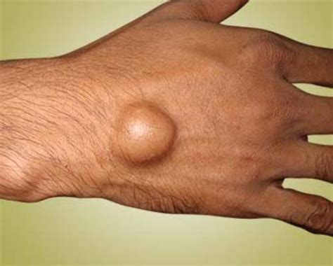 Why Having A Bump On Your Wrist May Be A Cause For Concern