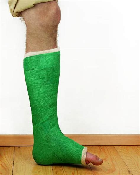 Broken Ankle In A Cast Poster By Cordelia Molloy