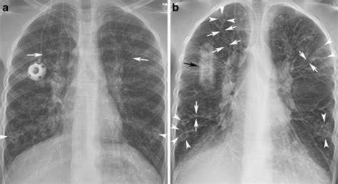 This is partly because the lungs are often severely affected and the cause of significant morbidity and mortality. A 12-year-girl with cystic fibrosis. a The AP radiograp ...